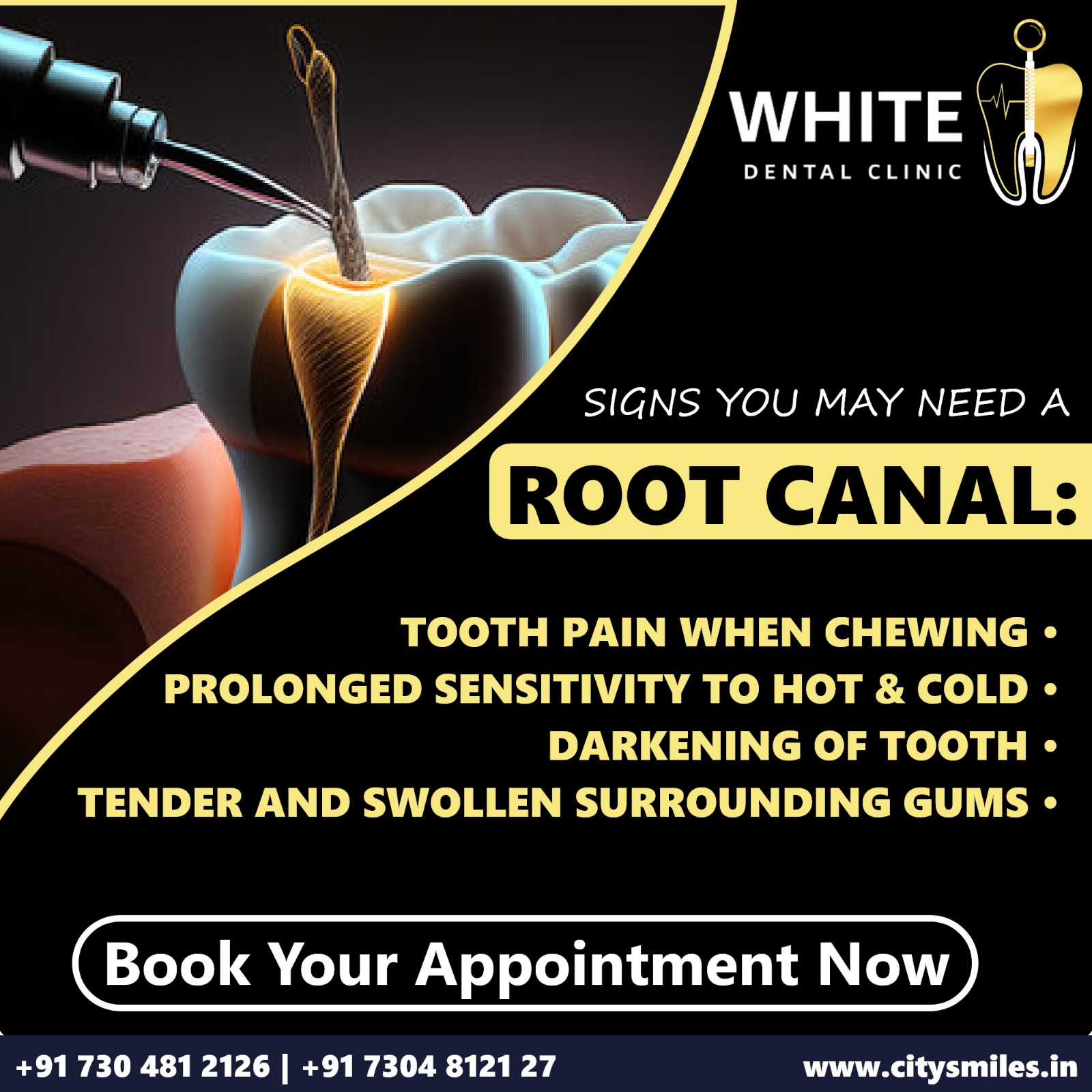Signs You May Need a Root Canal: What to Look For