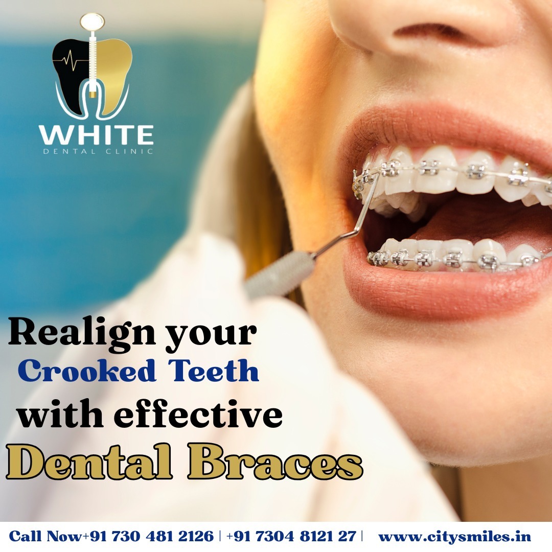  Struggling with Crooked Teeth? Let’s straighten that smile! 