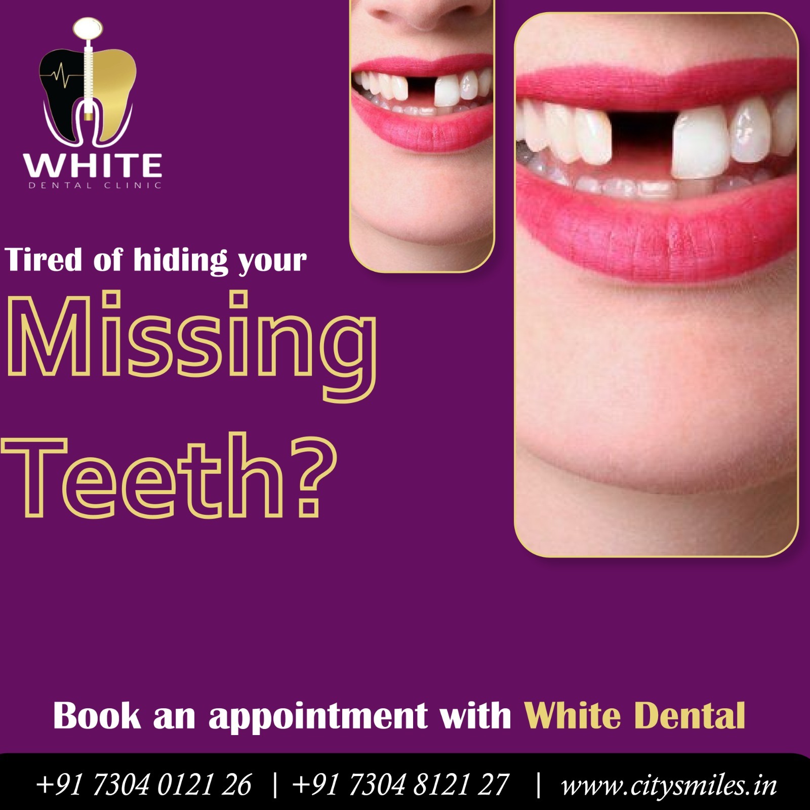 Tired of Hiding Your Missing Teeth