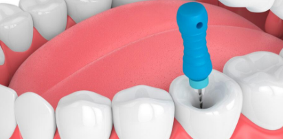 Single Sitting Root canal Treatment