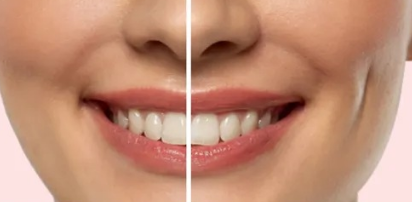 Dimploplasty