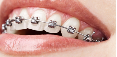 Conventional Braces