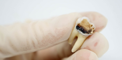 Non - Vital Tooth