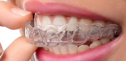 Invisible Braces