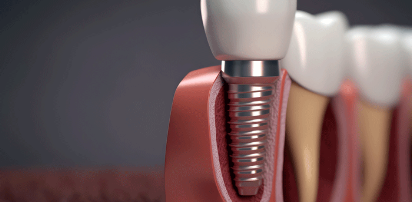 Full mouth implants 