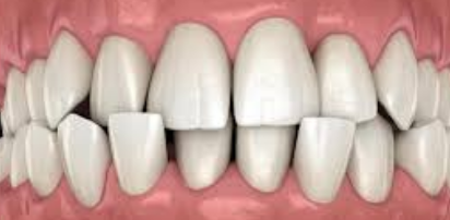 Crowded Teeth