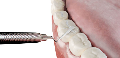 Filling of cavity