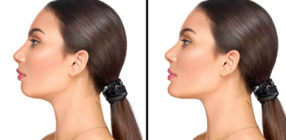 Chin Augmentation