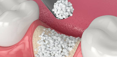 Bone Graft