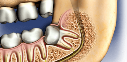 Removal of Impacted tooth
