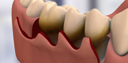 Flap Surgery