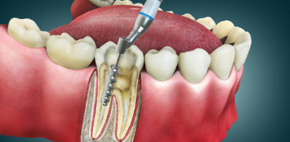 Root Canal Treatment