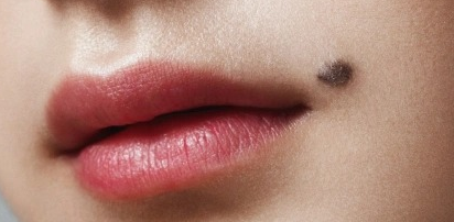 Mole wart & skin tag removal