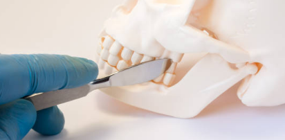 Maxillofacial Plating