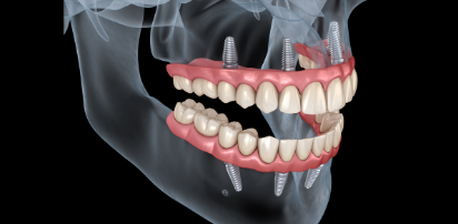 Complete Dentures