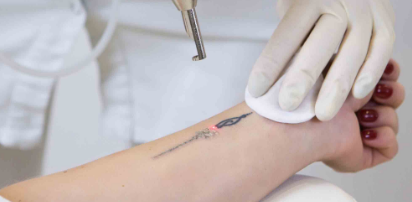Tatoo removal
